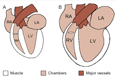 Dilated cardiomyopathy